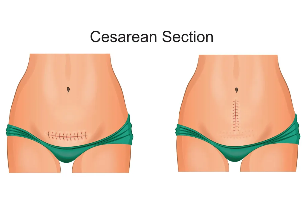 C-section Delivery- Procedure, Reasons, Recovery & more