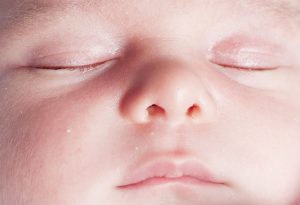 What Causes Milia in Newborns