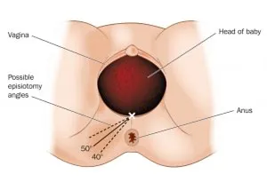 perineum irritation