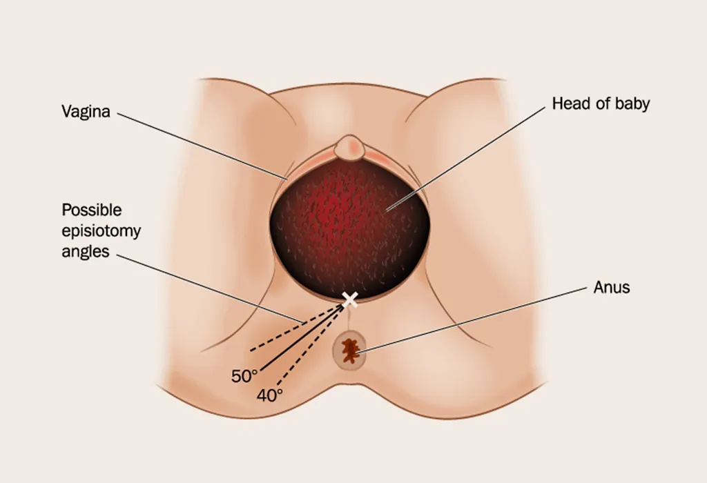 When Is Episiotomy Needed?