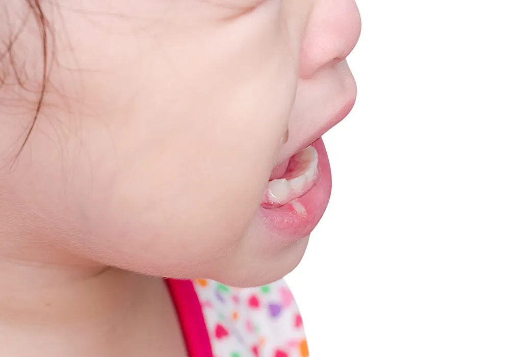 Mouth Ulcers in kids