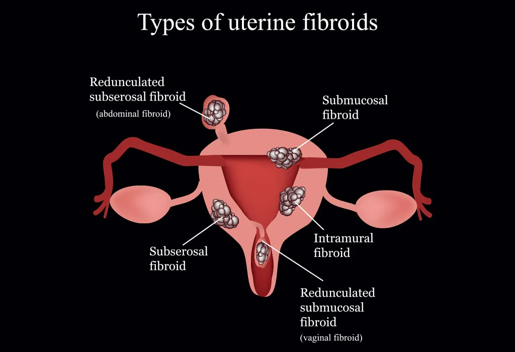 Cervical Fibroids Cervical Fibroids