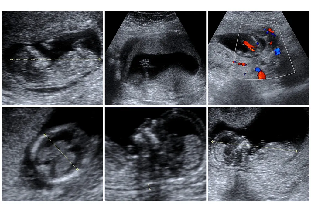 Colour Doppler