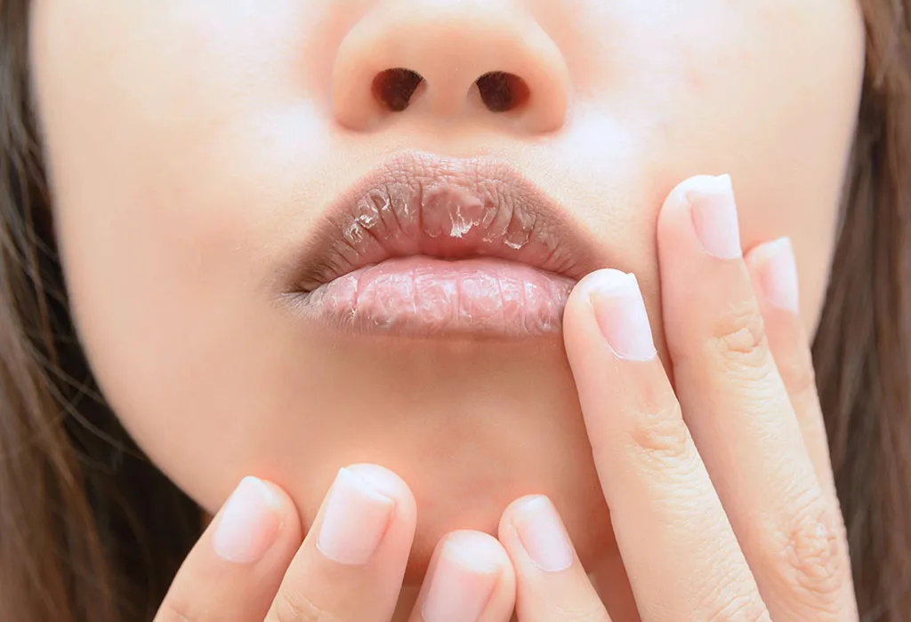 Dry lips during pregnancy