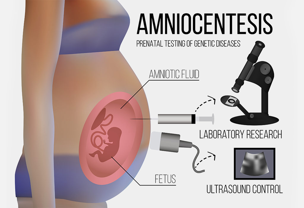 What is Amniocentesis?