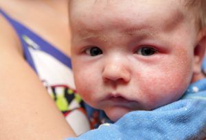 Signs of Eczema in Babies