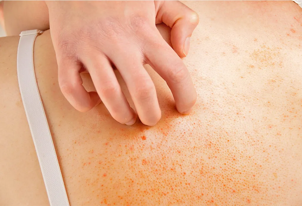Symptoms of Chickenpox in Pregnant Women