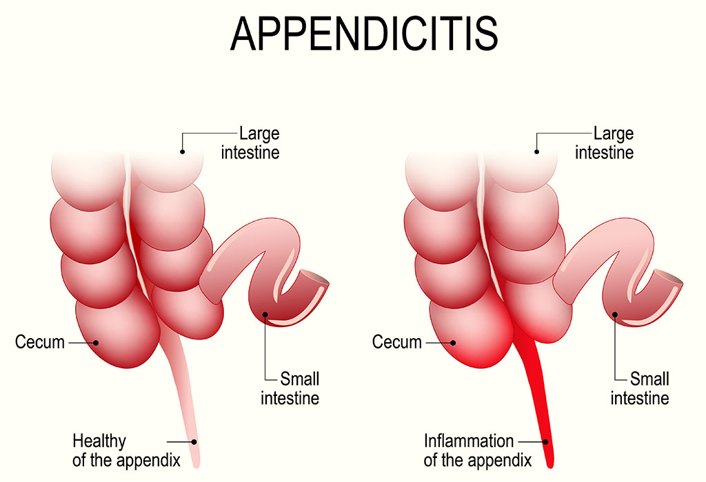 What Causes Appendicitis In Children?