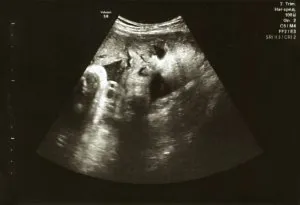 Ultrasound Scan at 33 Weeks