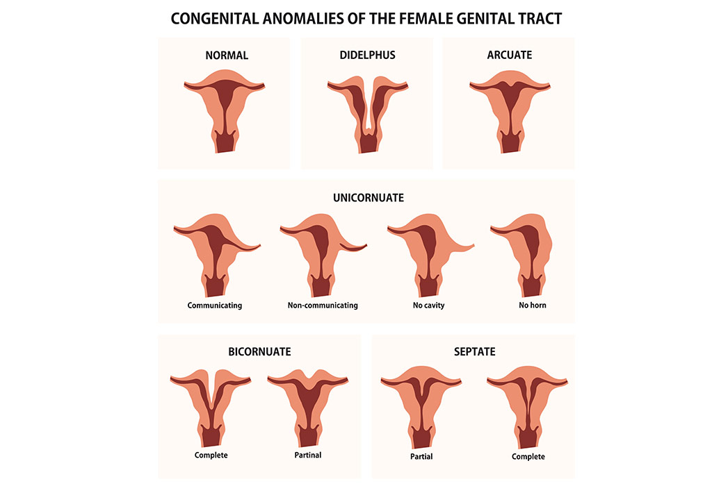 Different Types of Uterus Abnormalities