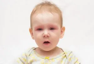 Causes of Slapped Cheek Syndrome in Babies and Toddlers