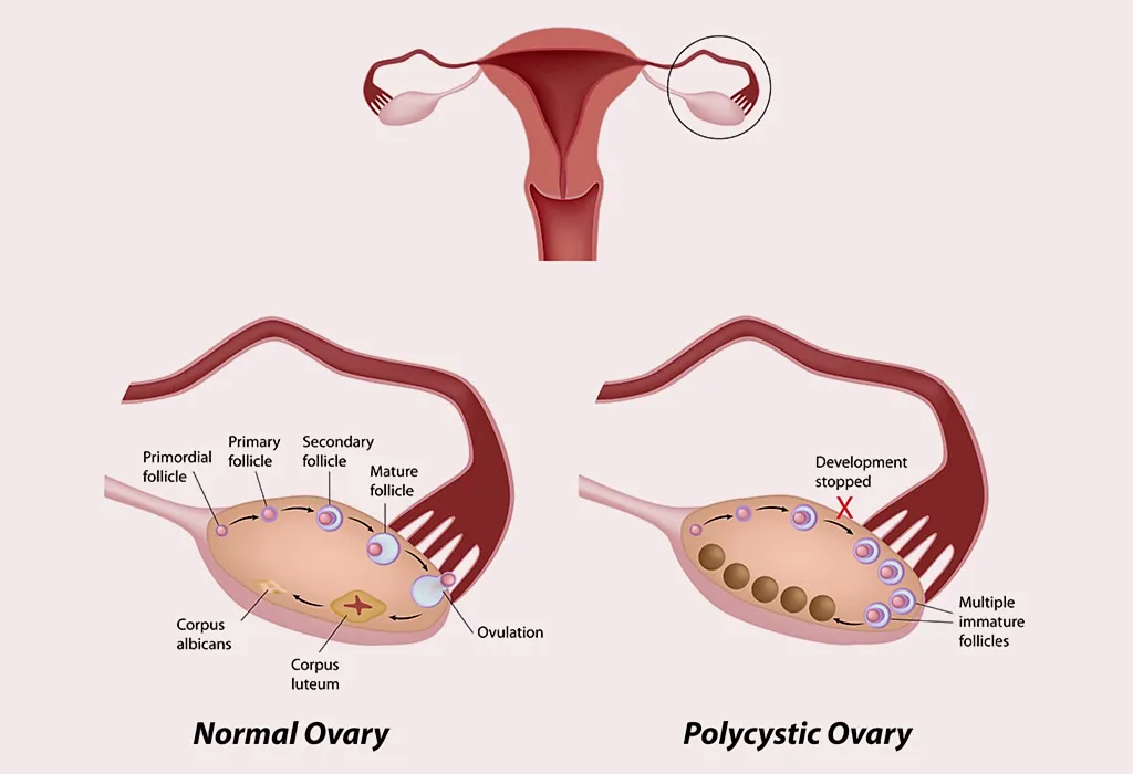 Who Is at a Greater Risk of Developing OHSS?