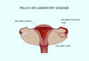 Cramps But No Period Reasons Signs Remedies