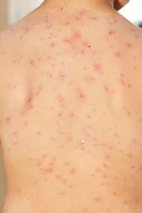 Chicken Pox