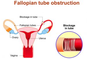 What Are Blocked Fallopian Tubes