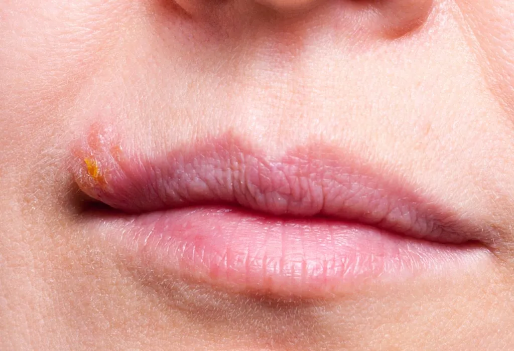 Herpes Simplex