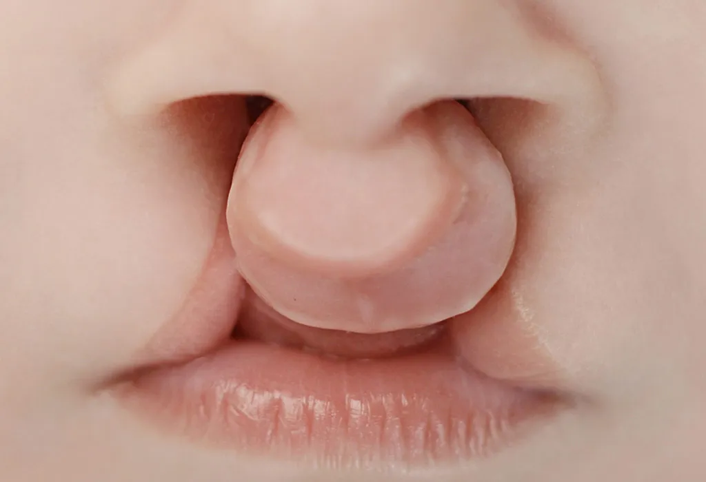 What Do Cleft Lip and Palates Look Like?