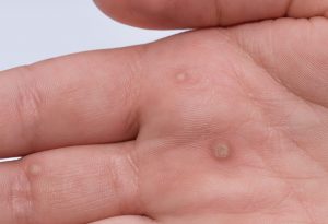 Warts on hands and fingers
