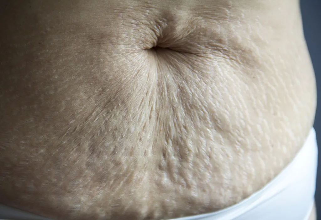 Saggy Belly Skin After Pregnancy: What To Do And What To Avoid