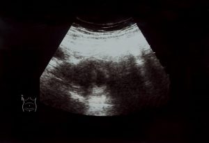 6 Weeks Ultrasound