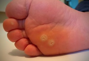 Wart foot child - Photographic Atlas of Pediatric Disorders and Diagnosis Wart toddler foot