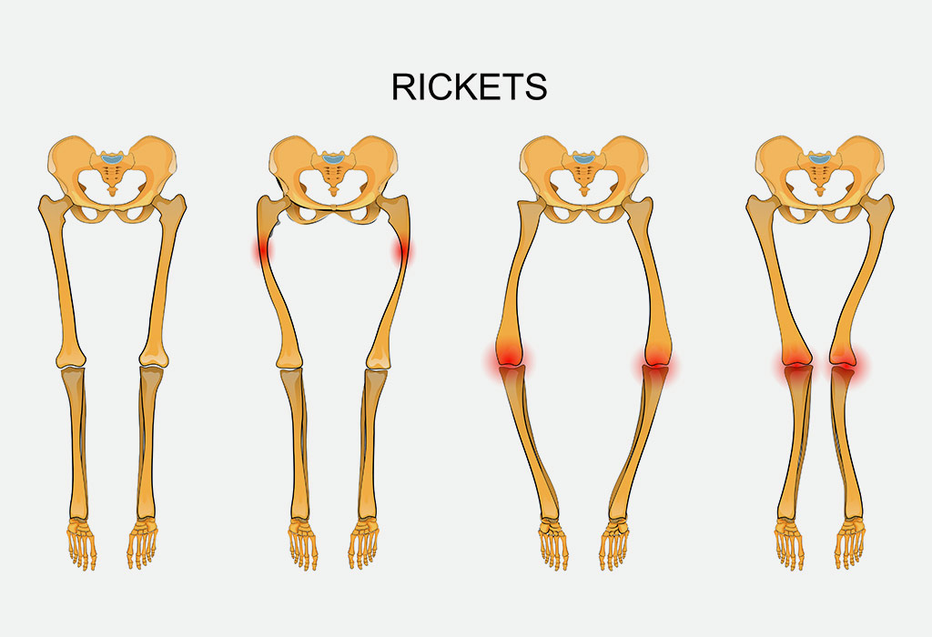 Rickets Signs and Symptoms in Kids 