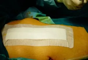 Caesarean Section Incisions Closed