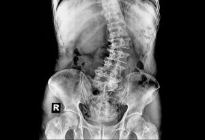 X-ray of curved spine