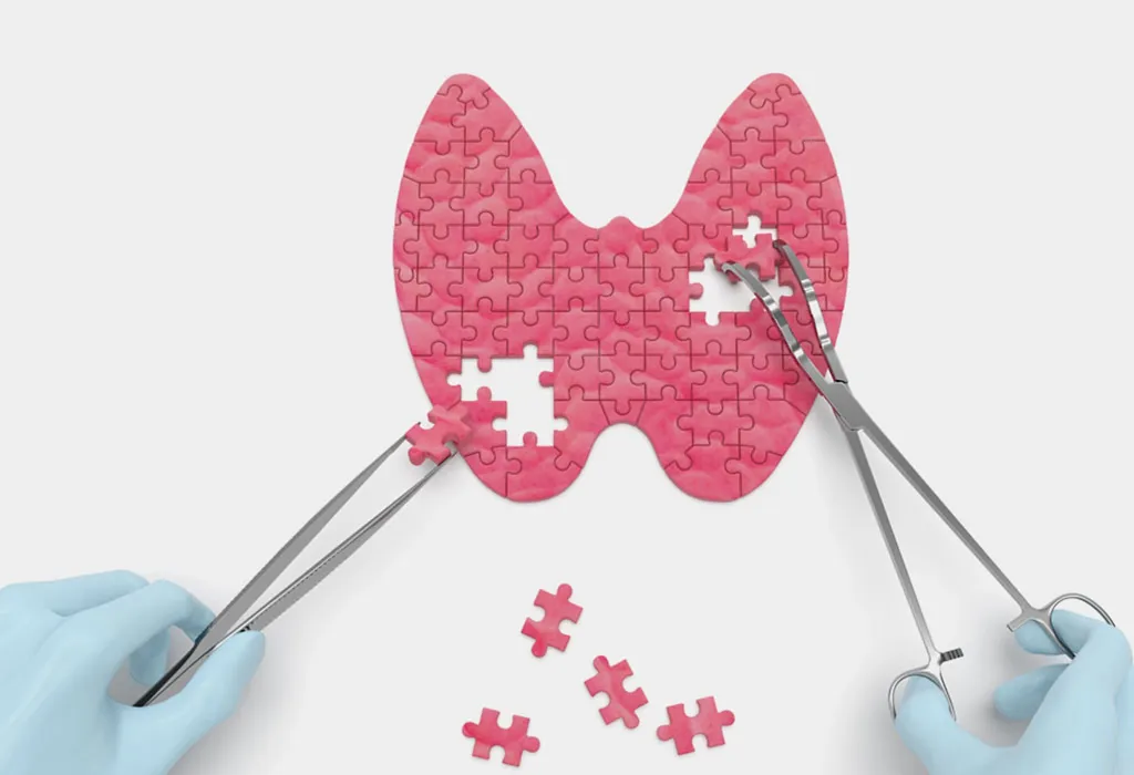 Causes of hypothyroidism
