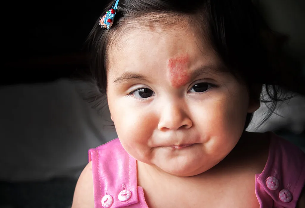 Are Birthmarks a Symptom of Any Disorder?