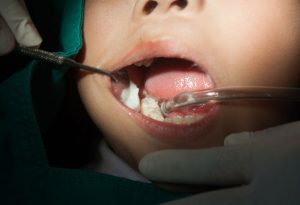 child teeth filling