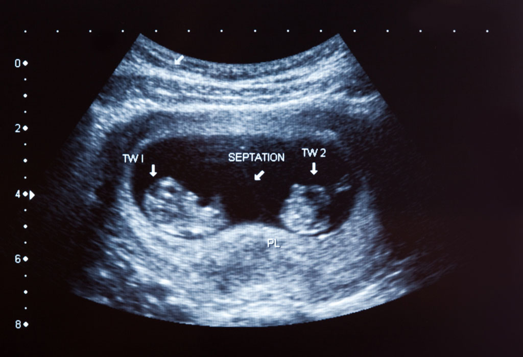 Ultrasound of twins