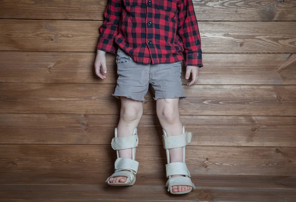Clubfoot Treatment