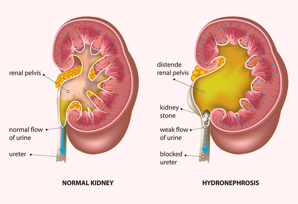 What Is Hydronephrosis?