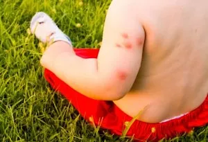 Mosquito Bite in Kids