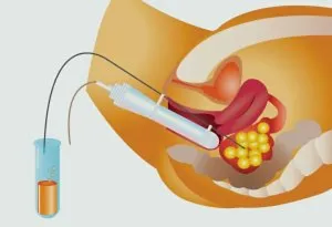 Intra-uterine Insemination