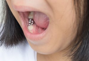 Silver crown teeth in young girl  child mouth