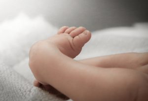 Signs & Symptoms of Clubfoot in Babies