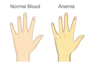 Yellow skin is one of the most common symptoms of Anaemia