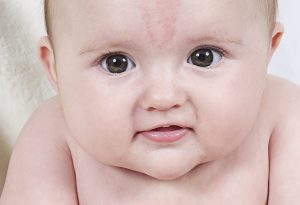 What Are the Causes of Birthmarks?