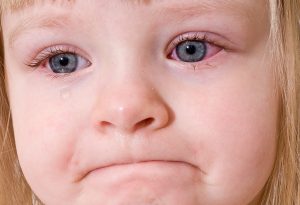 Is Pink Eye Contagious?