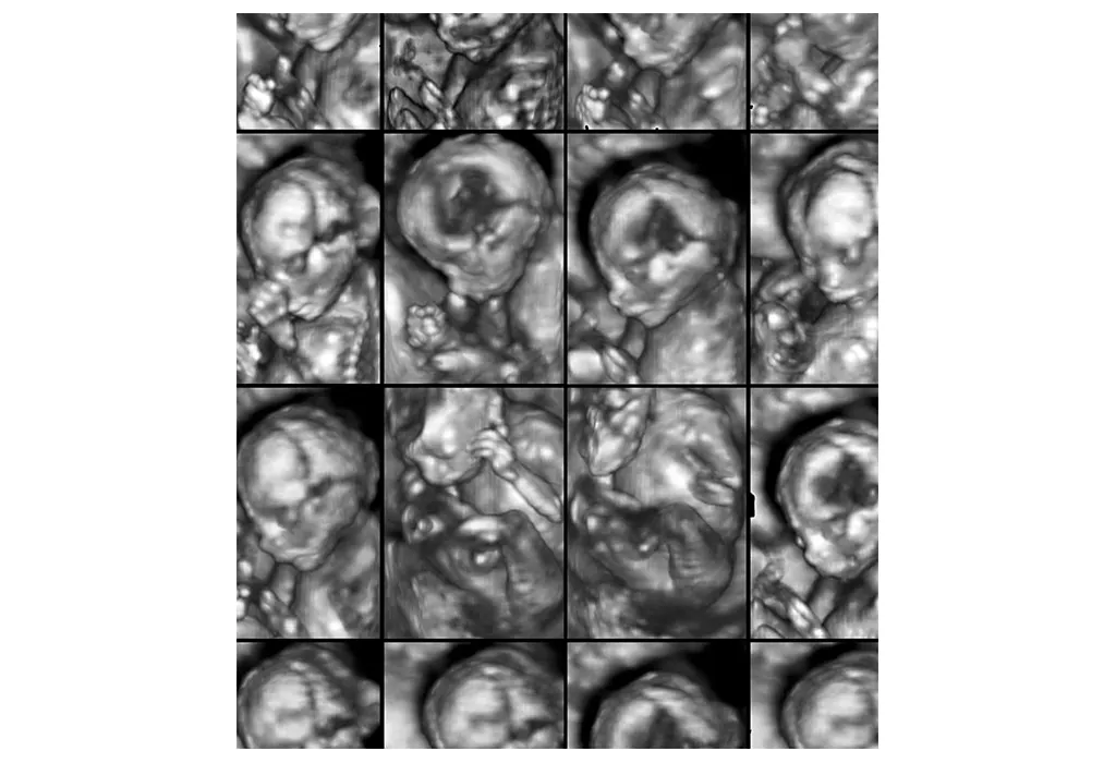 Images of 3D ultrasound anomaly scan on a female foetus four months into the pregnancy