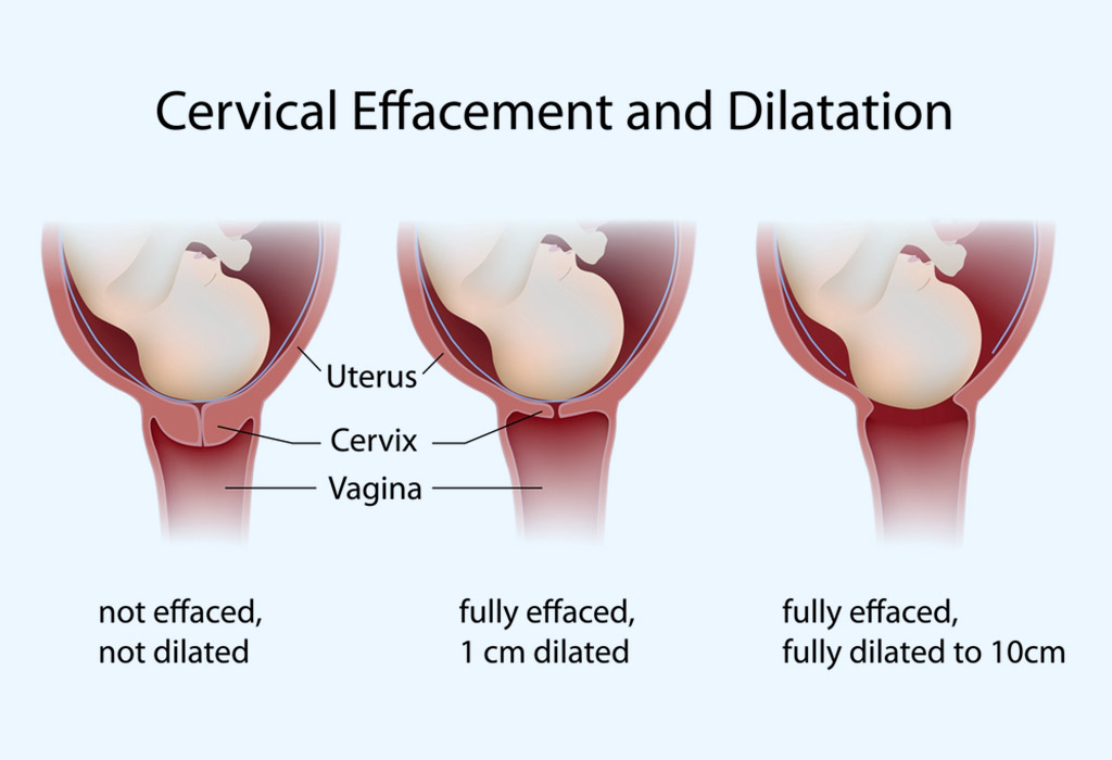 CERVICAL EFFACEMENT AND DILATION