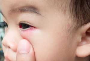 A little boy with a swollen red eye