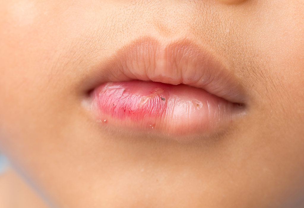 SIGNS OF ALLERGY