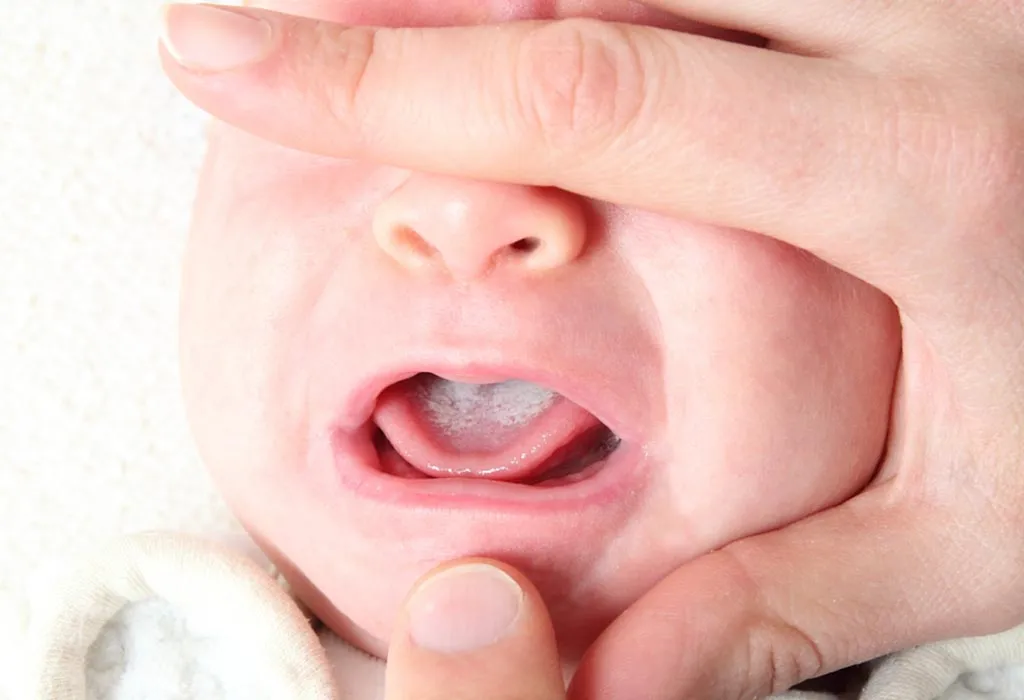 Oral thrush in babies