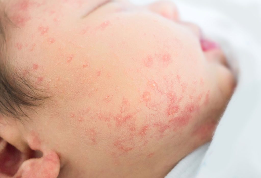 Baby Rash On Face Types Reasons And Home Remedies