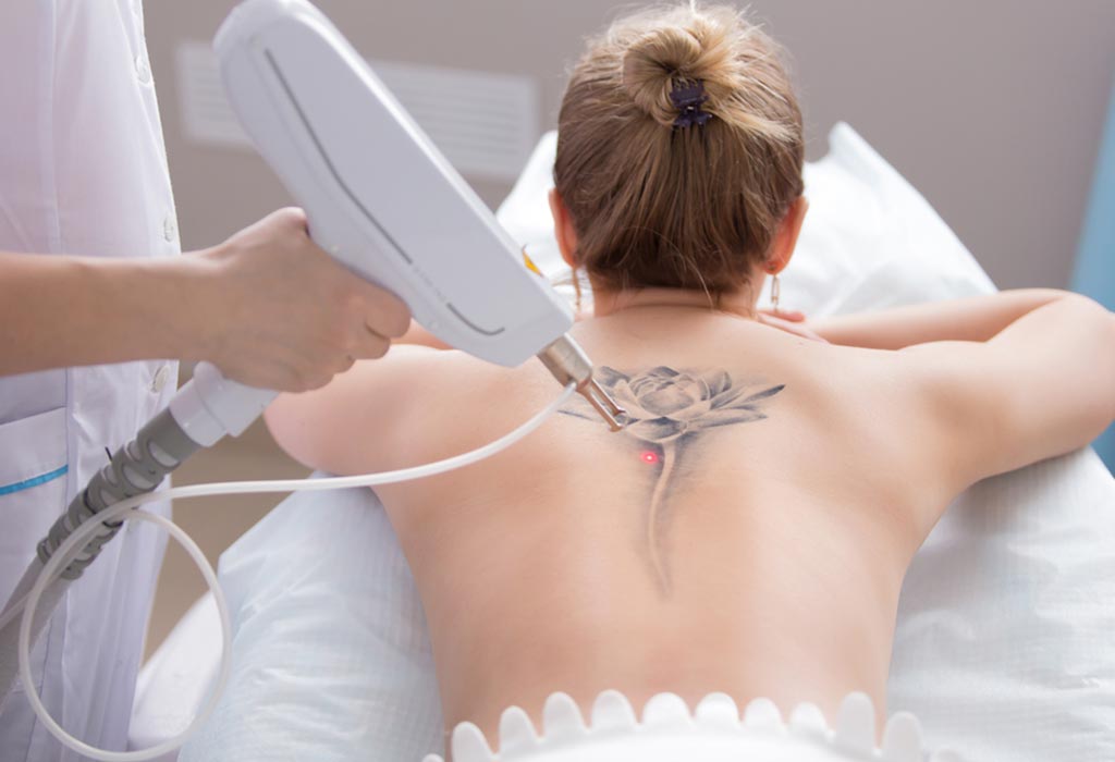 Is It Safe to Remove Tattoos While Nursing?