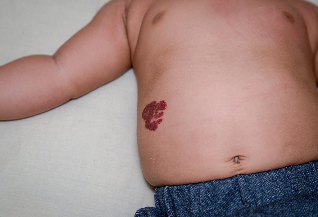 A baby with Infantile Hemangioma
