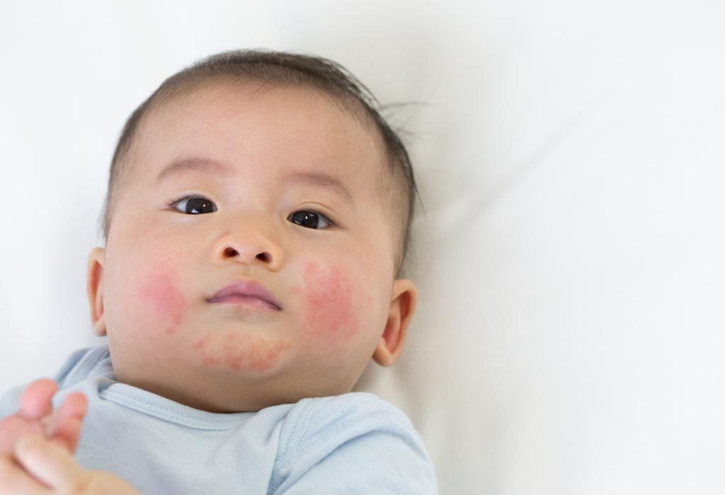 A baby with rashes on the cheeks